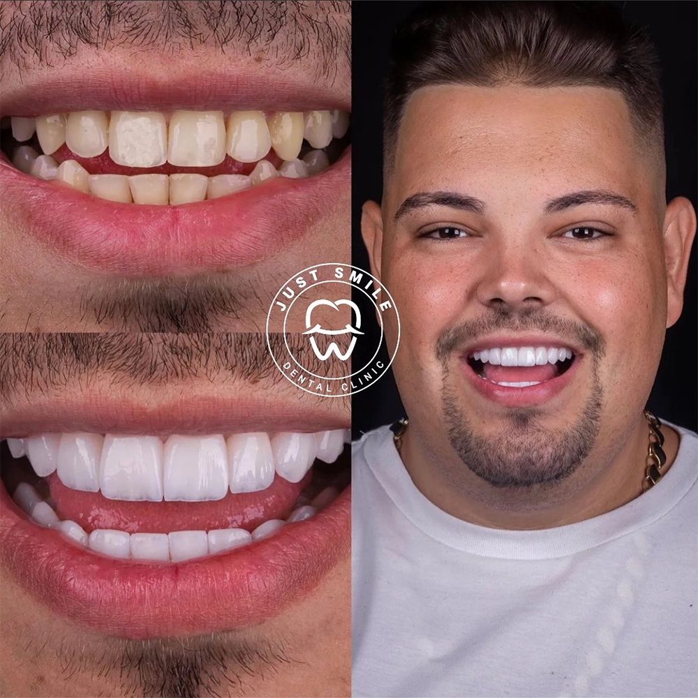 Before & After — Olivia Bennett, Smile Makeover