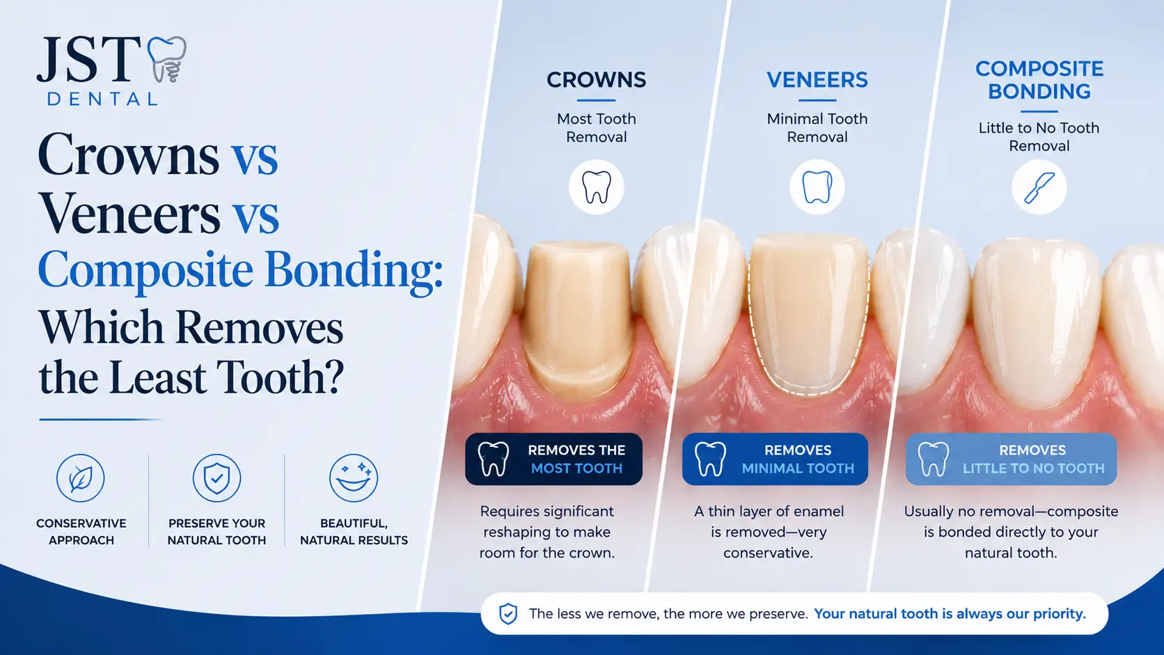 Crowns vs Veneers vs Composite Bonding: Which Removes the Least Tooth?