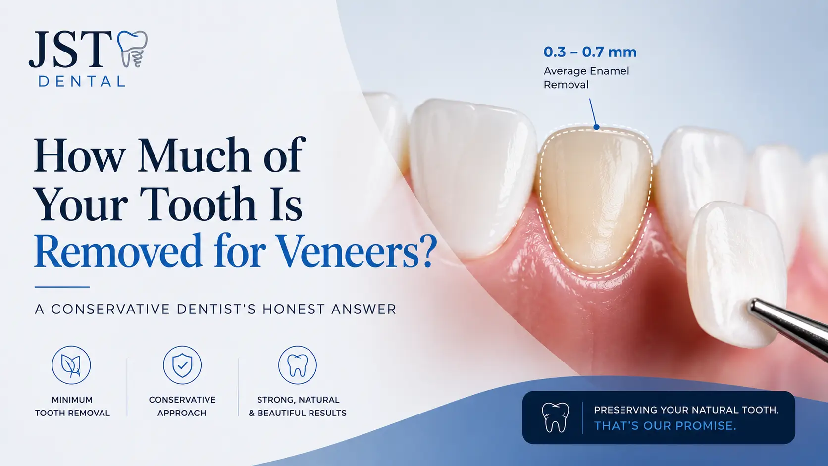How Much of Your Tooth Is Removed for Veneers? A Conservative Dentist’s Honest Answer